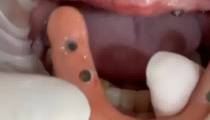 ایمپلنت و ست کامل دندان مصنوعی ردیف بالا