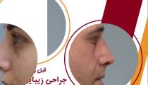 رینوپلاستی توسط بهترین جراح و متخصص جراحی های زیبایی صورت
