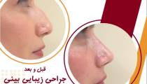 قبل و بعد جراحی زیبایی  بینی