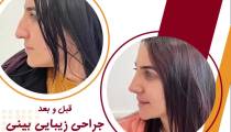 نمونه کار قبل وبعد جراحی بینی گوشتی و استخوانی
