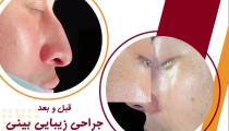 ویدیو قبل و بعد جراحی زیبایی بینی