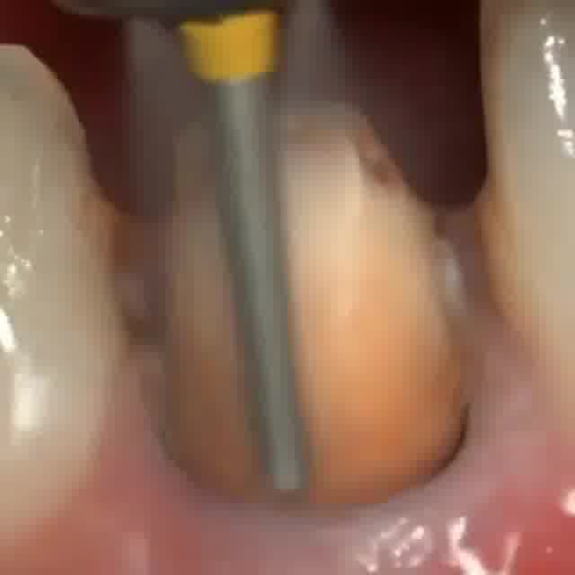 تراش دندان در دندانپزشکی