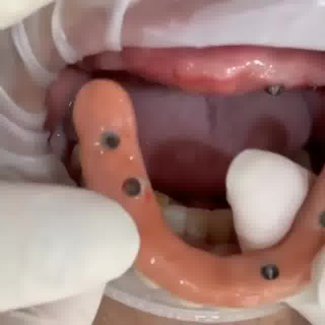 ایمپلنت و ست کامل دندان مصنوعی ردیف بالا