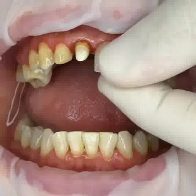 چگونگی نصب روکش دندان